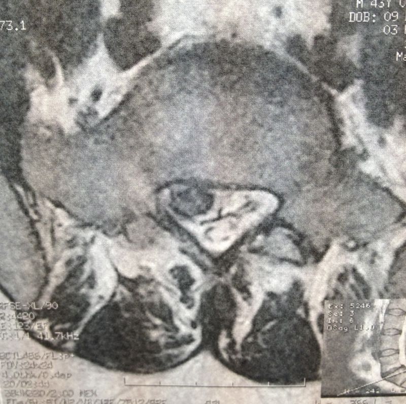 Hernie discale lombaire • Chirurgie de la colonne vertébrale