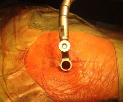 Ablation d'une hernie discale par technique mini-invasive (incision de 15mm seulement)
