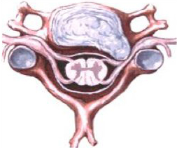 Hernie discale foraminale gauche comprimant la racine nerveuse.
