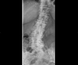Scoliose lombaire dégénérative chez une patiente de 73 ans.